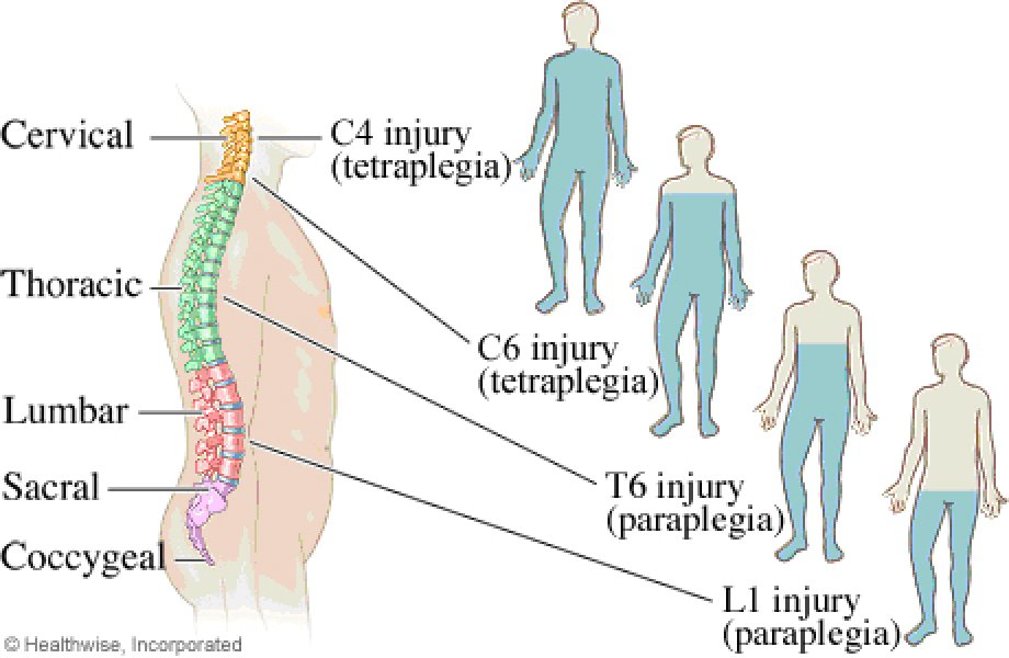 Параплегия. Параплегия и квадриплегия. Параплегия это в медицине. Параплегия справа.